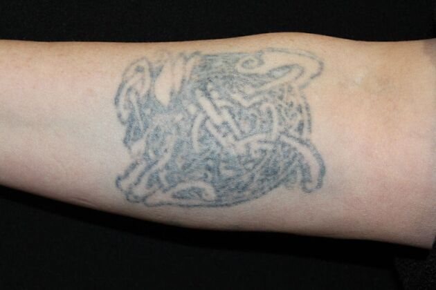 Laser Tattoo Removal Case 13 - After