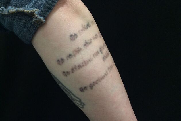 Laser Tattoo Removal: Case 13 - Before