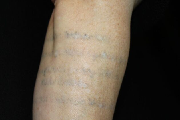 Laser Tattoo Removal: Case 13 - After