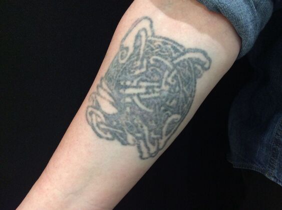 Laser Tattoo Removal Case 13 - Before