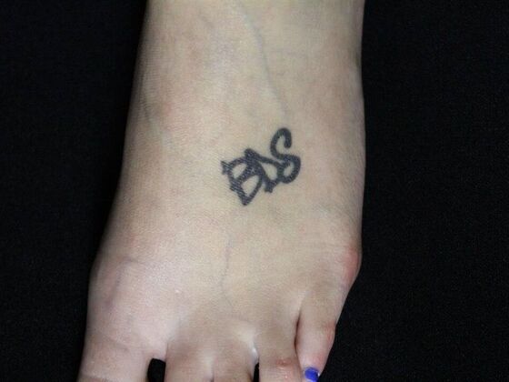 Laser Tattoo Removal Case 14 - Before