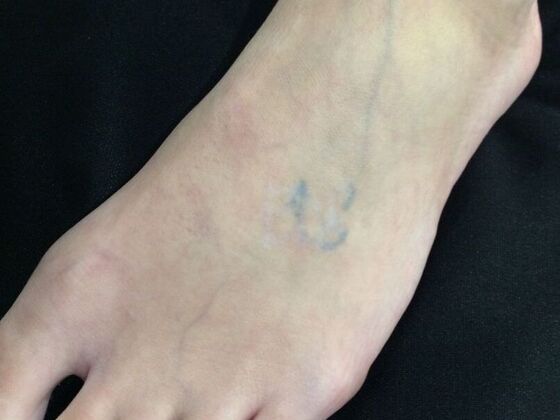 Laser Tattoo Removal Case 14 - After