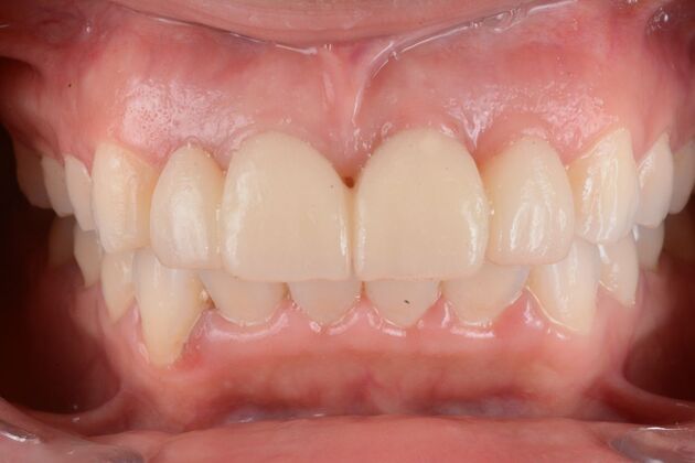Our Results: MULTIPLE IMPLANTS IN AESTHETIC AREA, TEETH IN A DAY - After