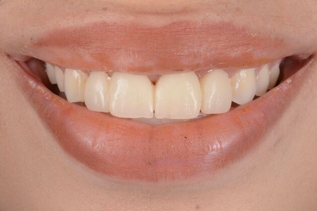 Our Results: MULTIPLE IMPLANTS IN AESTHETIC AREA, TEETH IN A DAY - After
