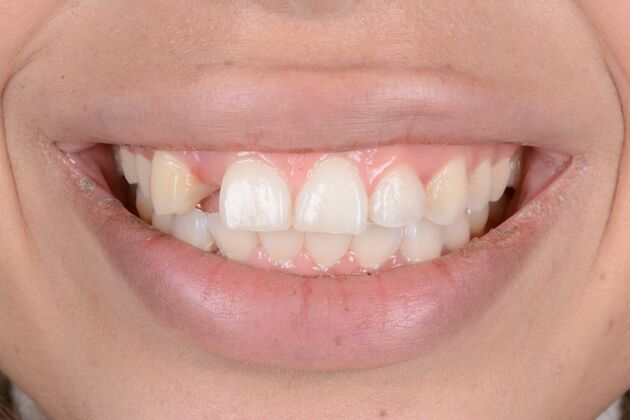 Our Results: MULTIPLE IMPLANTS IN AESTHETIC AREA, TEETH IN A DAY - Before