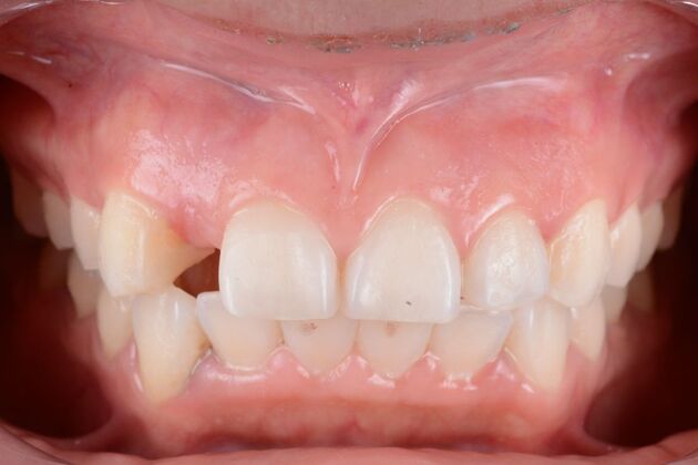 Our Results: MULTIPLE IMPLANTS IN AESTHETIC AREA, TEETH IN A DAY - Before