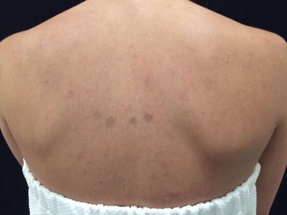 Laser Tattoo Removal Case 15 - After