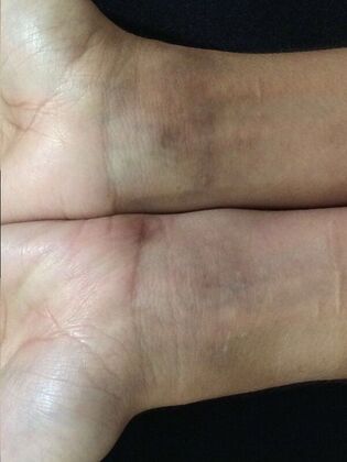 Laser Tattoo Removal Case 16 - After