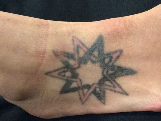 Laser Tattoo Removal Case 17 - Before