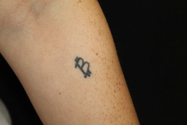 Laser Tattoo Removal Case 18 - Before
