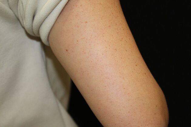 Laser Tattoo Removal Case 18 - After