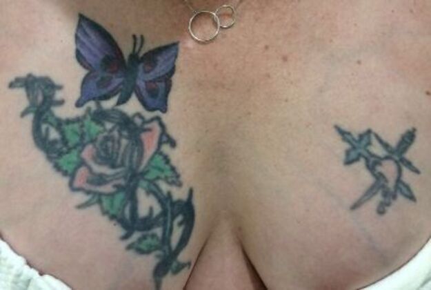 Laser Tattoo Removal Case 19 - Before