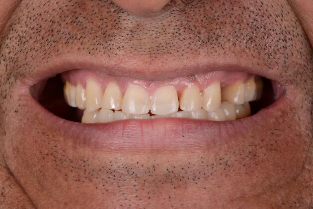 Our Results: LOWER ALL ON 6, TEETH IN A DAY, UPPER FULL MOUTH RECONSTRUCTION - Before