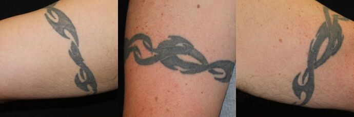 Laser Tattoo Removal Case 20 - Before