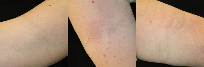 Laser Tattoo Removal Case 20 - After