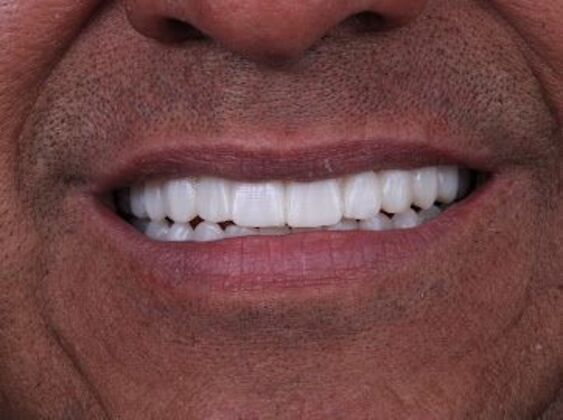 Our Results: LOWER ALL ON 6, TEETH IN A DAY, UPPER FULL MOUTH RECONSTRUCTION - After