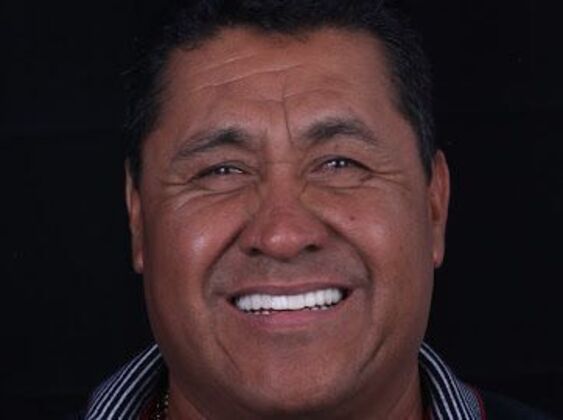 Our Results LOWER ALL ON 6, TEETH IN A DAY, UPPER FULL MOUTH RECONSTRUCTION - After