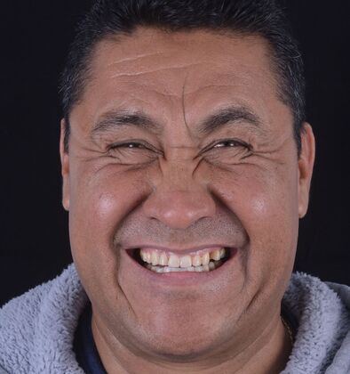 Our Results LOWER ALL ON 6, TEETH IN A DAY, UPPER FULL MOUTH RECONSTRUCTION - Before