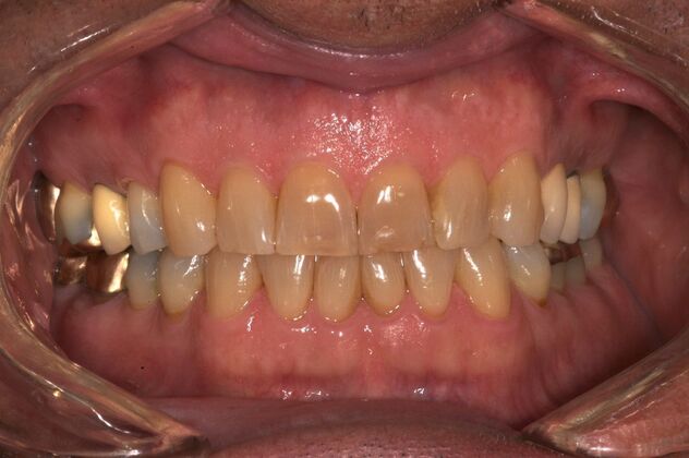 Veneers: Dave - Before