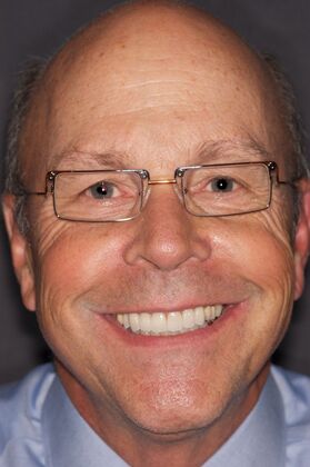 Veneers Dave - After