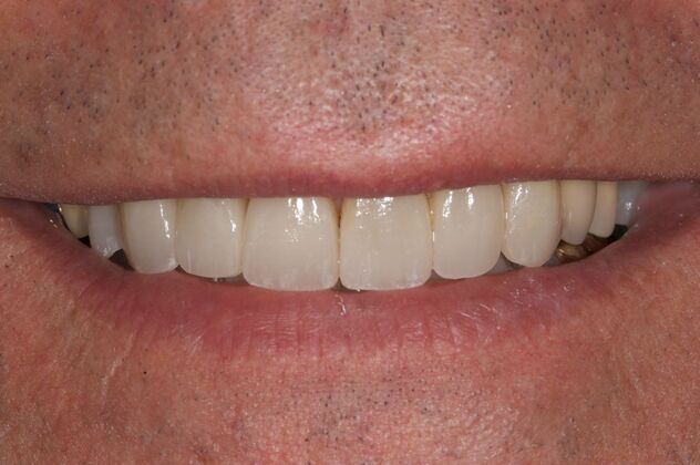 Veneers: Dave - After