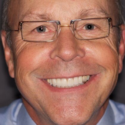 Smile Makeover Dave - After