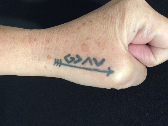 Laser Tattoo Removal Case 21 - Before