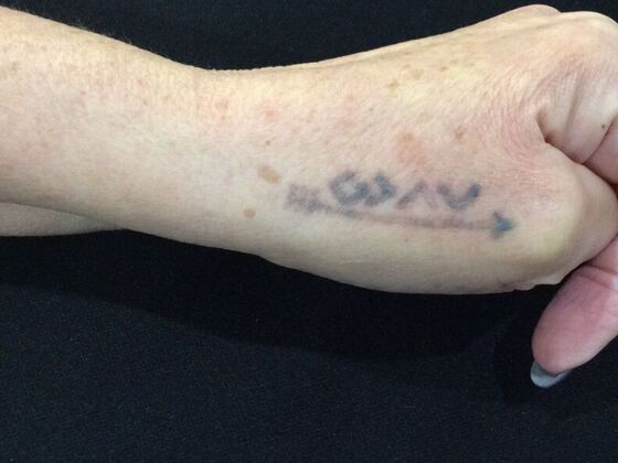 Laser Tattoo Removal Case 21 - After