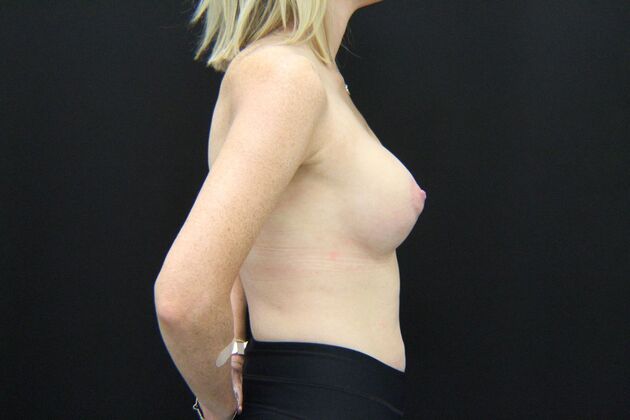 Breast Lift/Breast Lift Augmentation: Case 38 - After