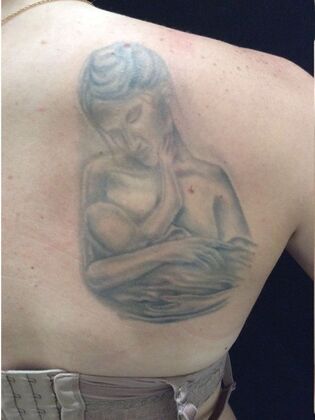 Laser Tattoo Removal Case 22 - Before
