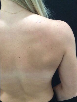 Laser Tattoo Removal Case 22 - After