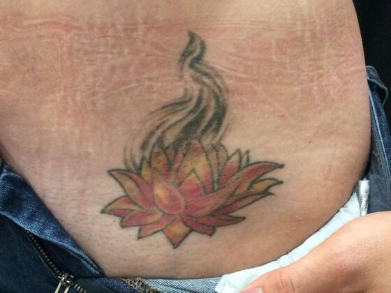 Laser Tattoo Removal Case 23 - Before