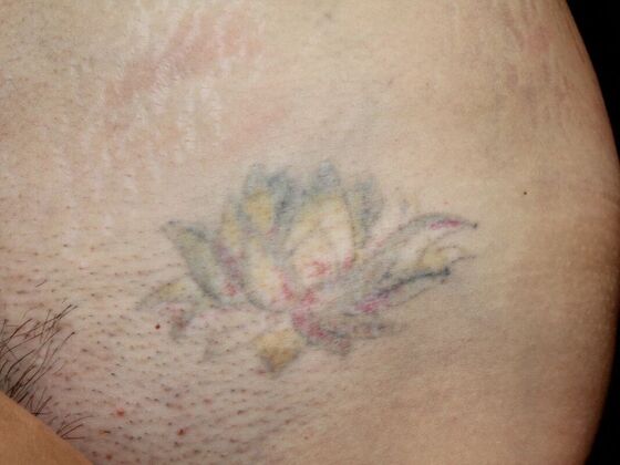 Laser Tattoo Removal Case 23 - After