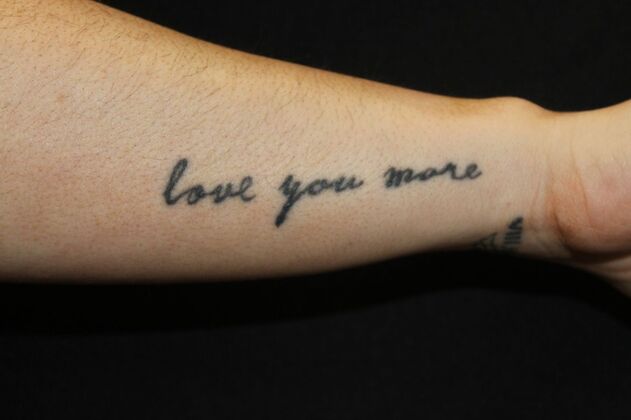 Laser Tattoo Removal Case 24 - Before