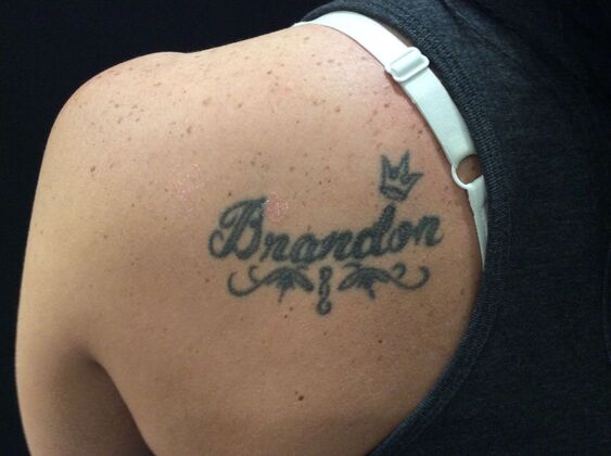 Laser Tattoo Removal Case 25 - Before