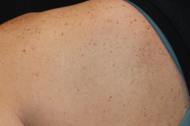 Laser Tattoo Removal Case 25 - After