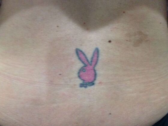 Laser Tattoo Removal Case 26 - Before