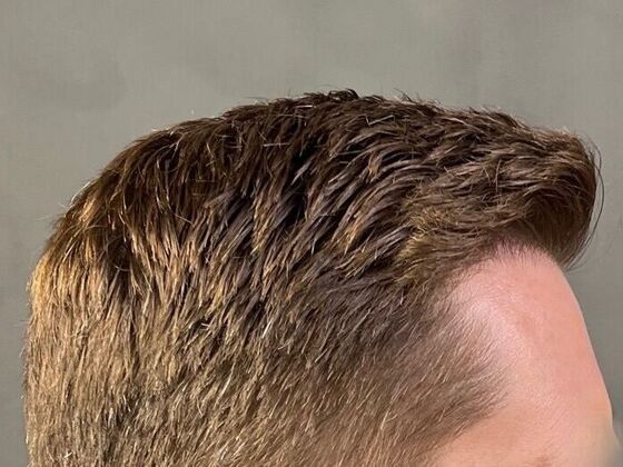 FUE Hair Restoration: Case 22 - After