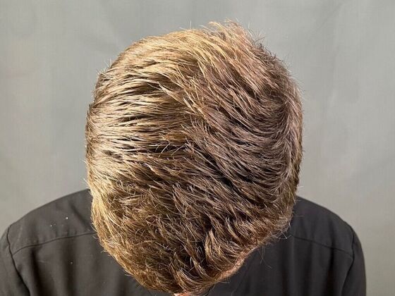 FUE Hair Restoration: Case 22 - After