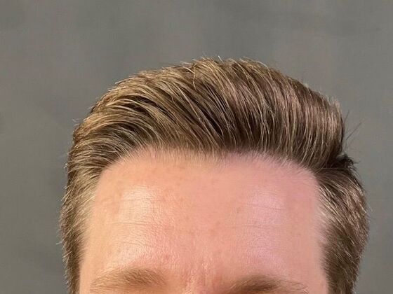 FUE Hair Restoration: Case 22 - After