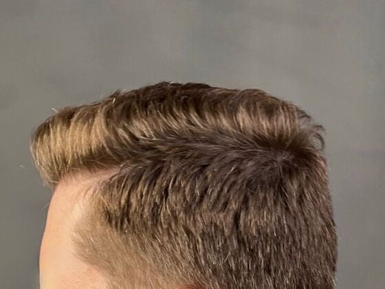 FUE Hair Restoration: Case 22 - After