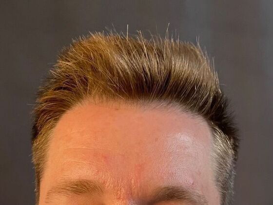 FUE Hair Restoration: Case 22 - Before