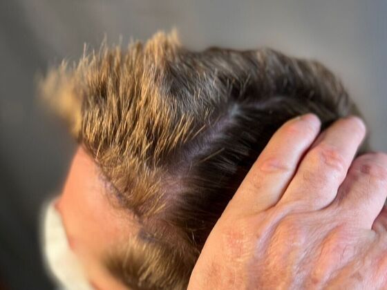 FUE Hair Restoration: Case 22 - Before