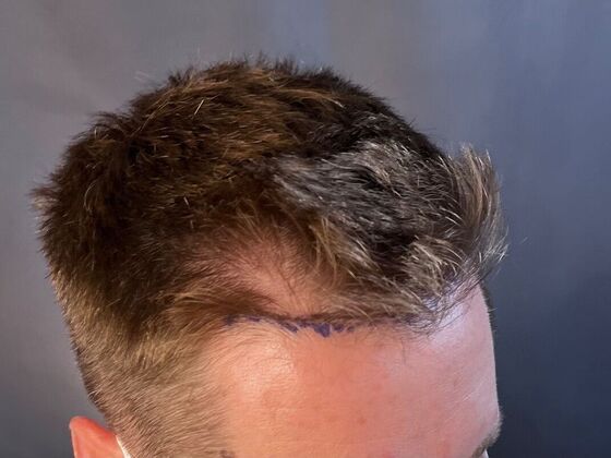 FUE Hair Restoration: Case 22 - Before
