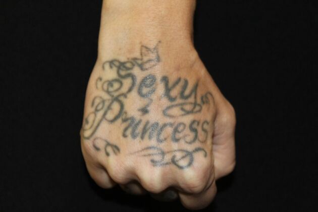 Laser Tattoo Removal Case 27 - Before