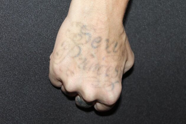 Laser Tattoo Removal Case 27 - After