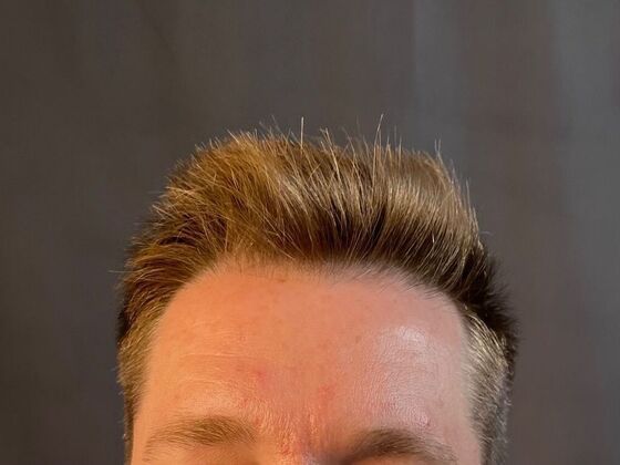 FUE Hair Restoration: Case 22 - Before