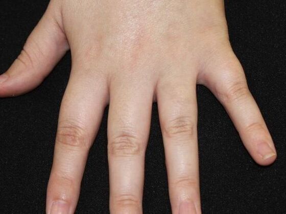 Laser Tattoo Removal Case 28 - After