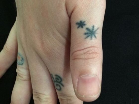 Laser Tattoo Removal Case 29 - Before