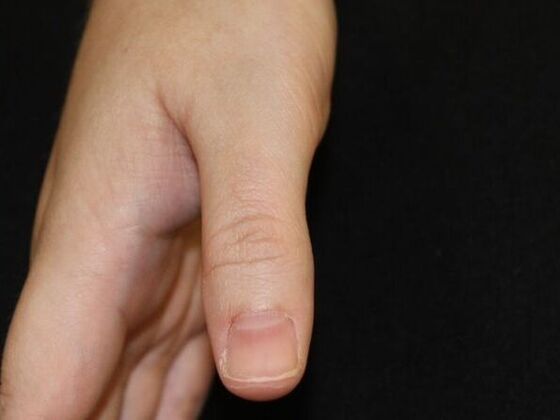 Laser Tattoo Removal Case 29 - After